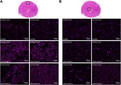 CCN2/CTGF—A Modulator of the Optic Nerve Head Astrocyte